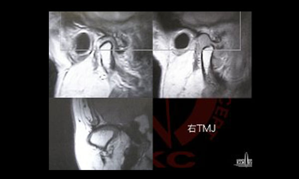 顎関節症治療