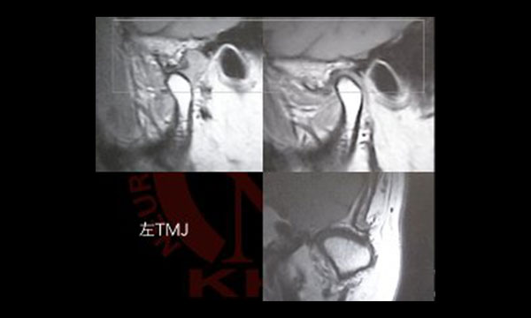 顎関節症治療